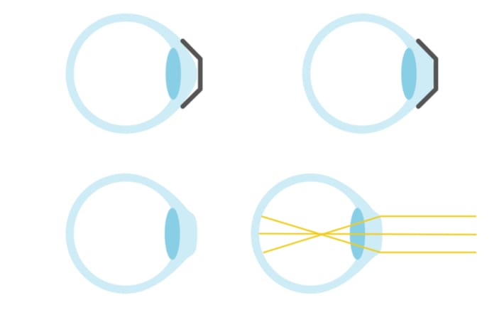 A diagram showing how corneal reshaping works before, during, and after wearing the lens