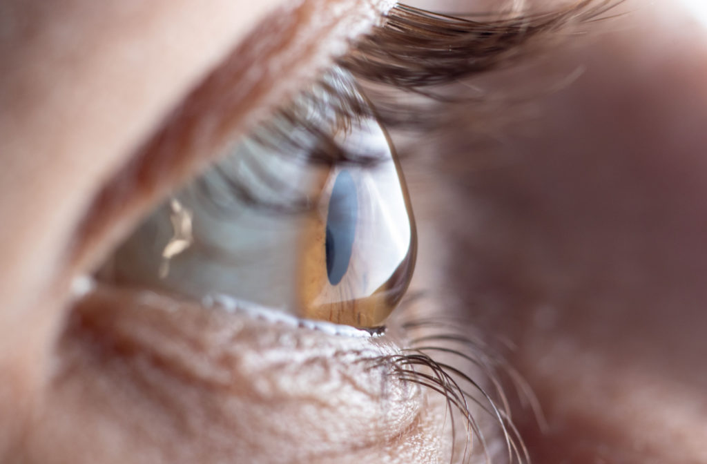 A close picture of an eye with astigmatism, an imperfection in the curvature of the eye that causes blurred distance and near vision.