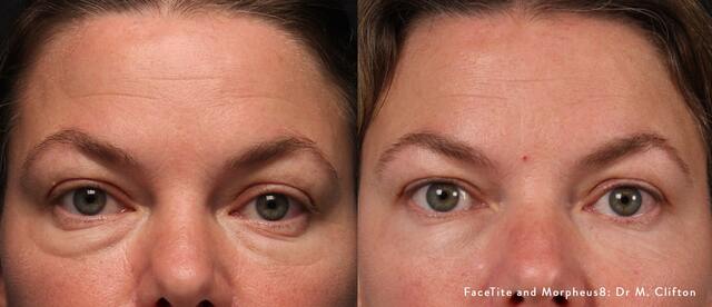 How Does Microneedling Treat Dark Circles Under the Eyes?