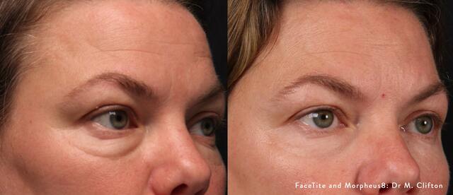 before and after image of a woman after FaceTite and Morpheus8 rf treatments. She is noticeable less wrinkled