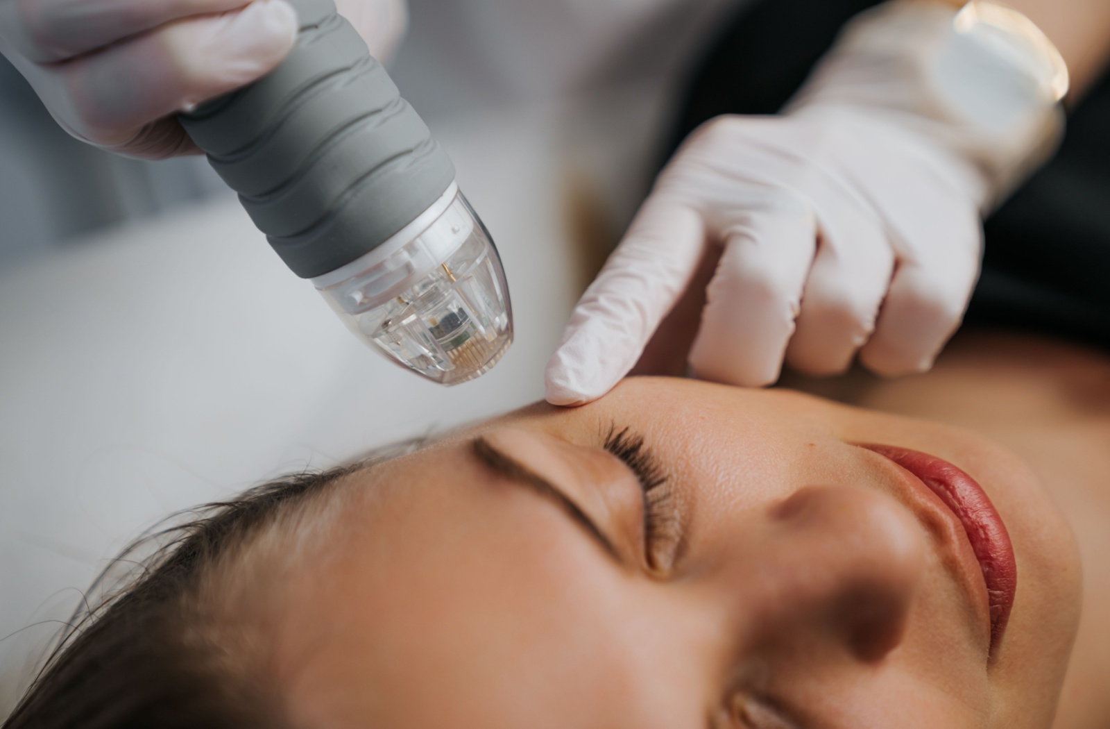 A patient undergoing radiofrequency treatment to unclog meibomian glands.