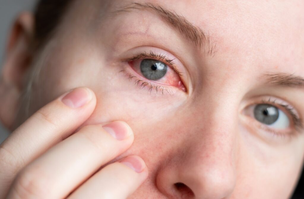 Close up of a person pulling the skin under their eye to better show their red eye caused by dry eye