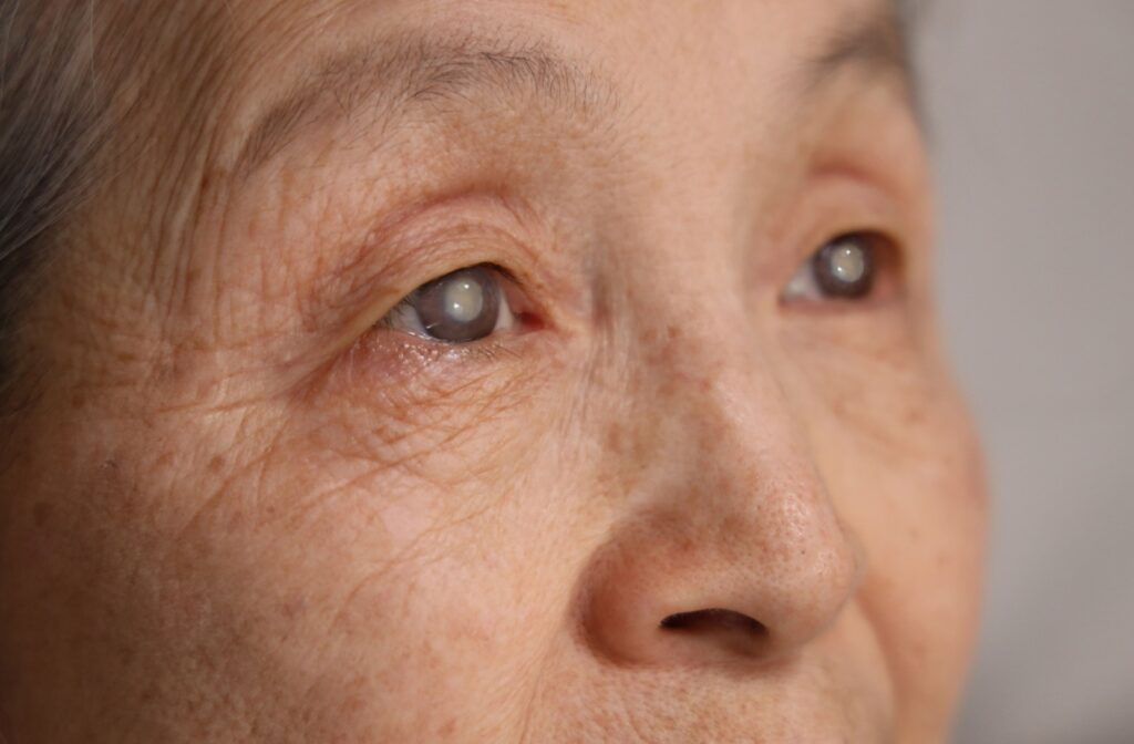 A close up of an elderly person's clouded eyes from glaucoma